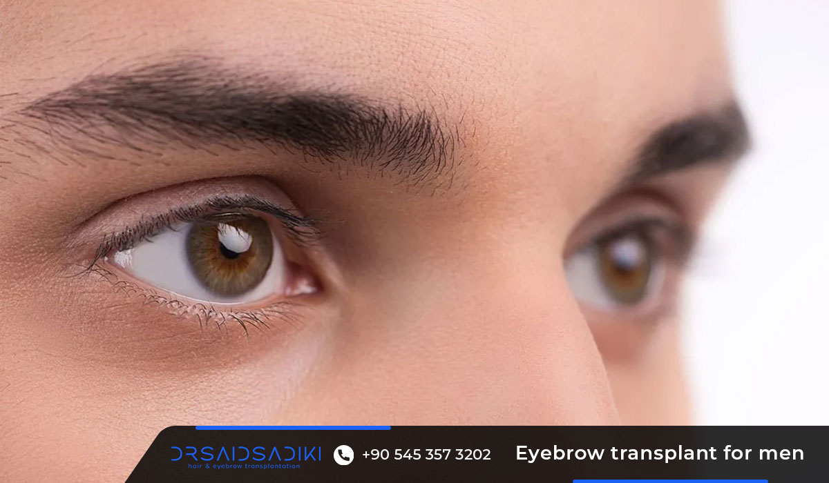 About Eyebrow Transplants