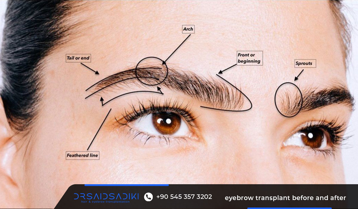 eyebrow transplant before and after 2 eyebrow transplant before and after