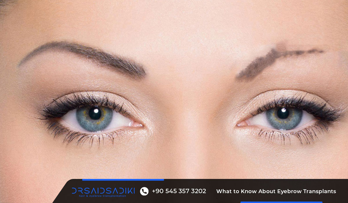 About Eyebrow Transplants