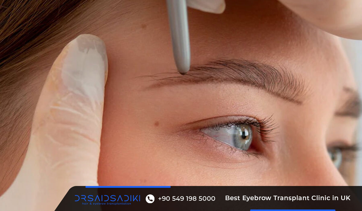 The Best Eyebrow Transplant Clinic in UK 4 Best Eyebrow Transplant Clinic in UK